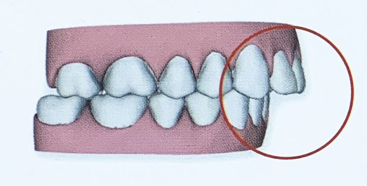 Protruded teeth