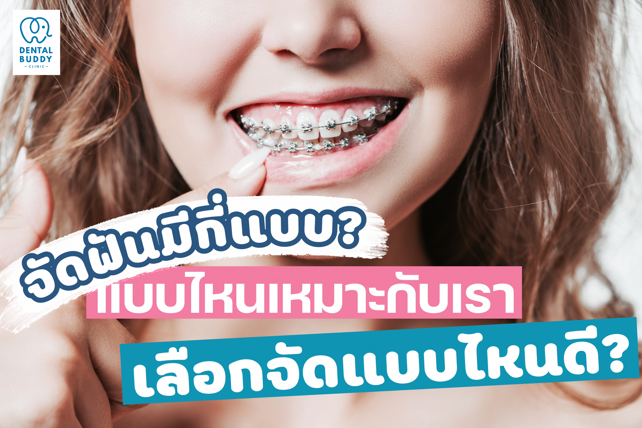 จัดฟันมีกี่แบบ แบบไหนเหมาะกับเรา