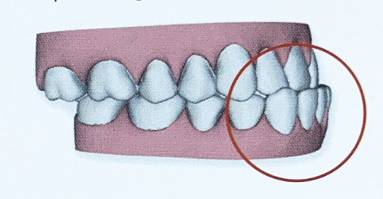 ฟันล่างคร่อมฟันบน ฟันล่างยื่น