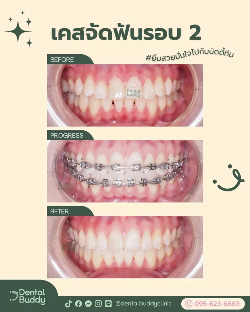 6522-56656 02 Front 3p