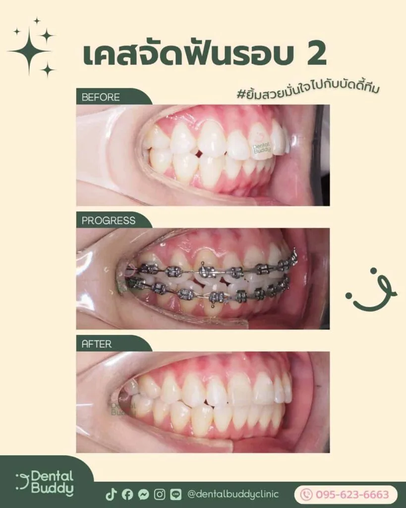 6522-56656 03 Left 3p