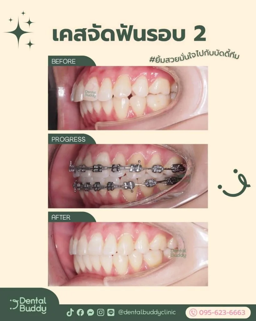 6522-56656 04 Right 3p