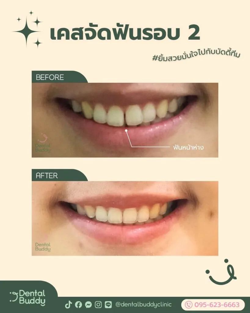 6522-56859 02.0 face 2p