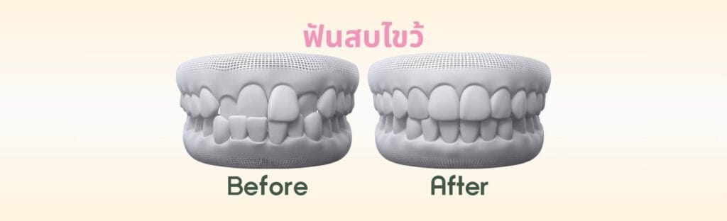 ฟันสบไขว้