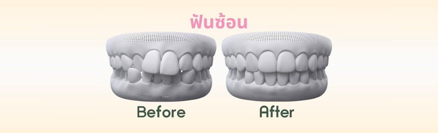 ฟันซ้อน