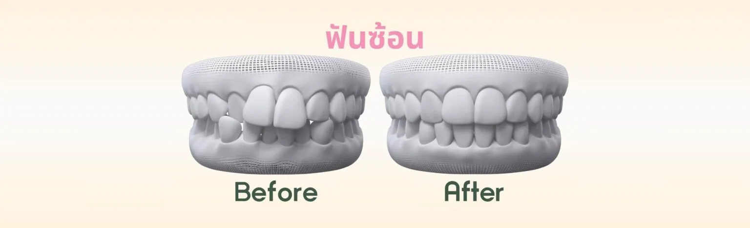 ฟันซ้อน