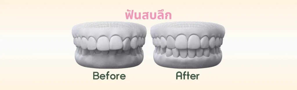 ฟันสบลึก