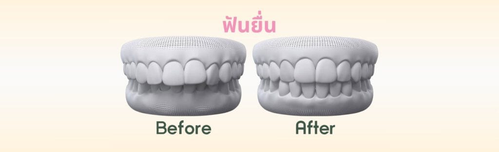 ฟันยื่น