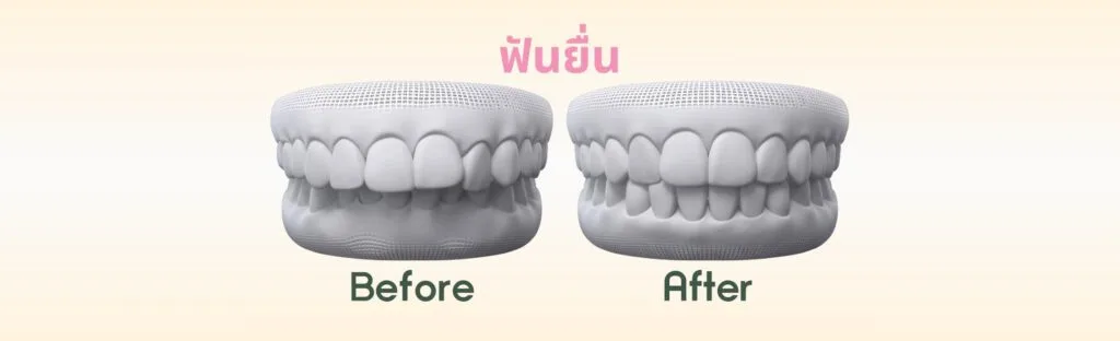 ฟันยื่น