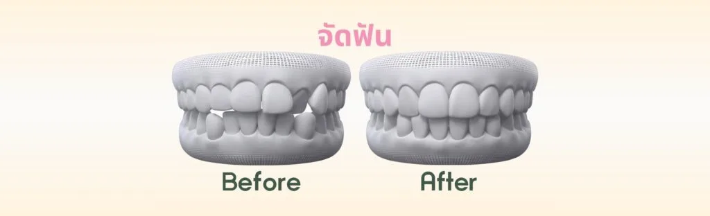 จัดฟันรอบสอง