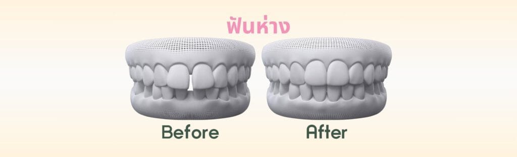 ฟันห่าง