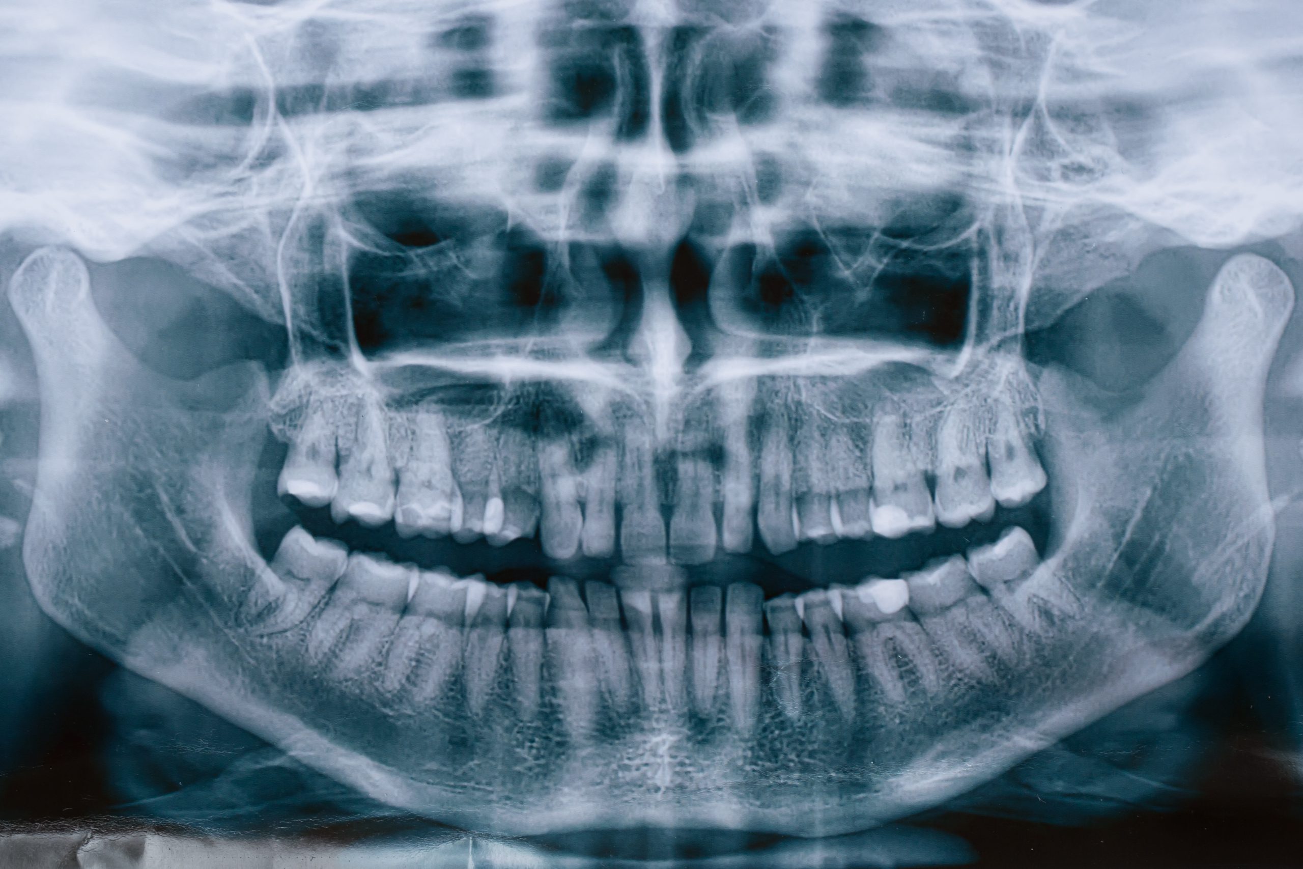 ถอนฟัน ผ่าฟันคุด x-ray จัดฟัน