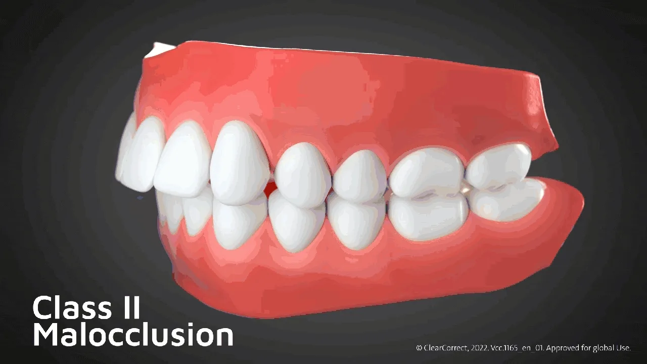 ฟันยื่น