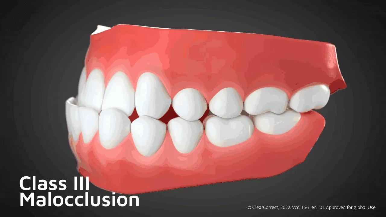 ฟันล่างคร่อมฟันบน