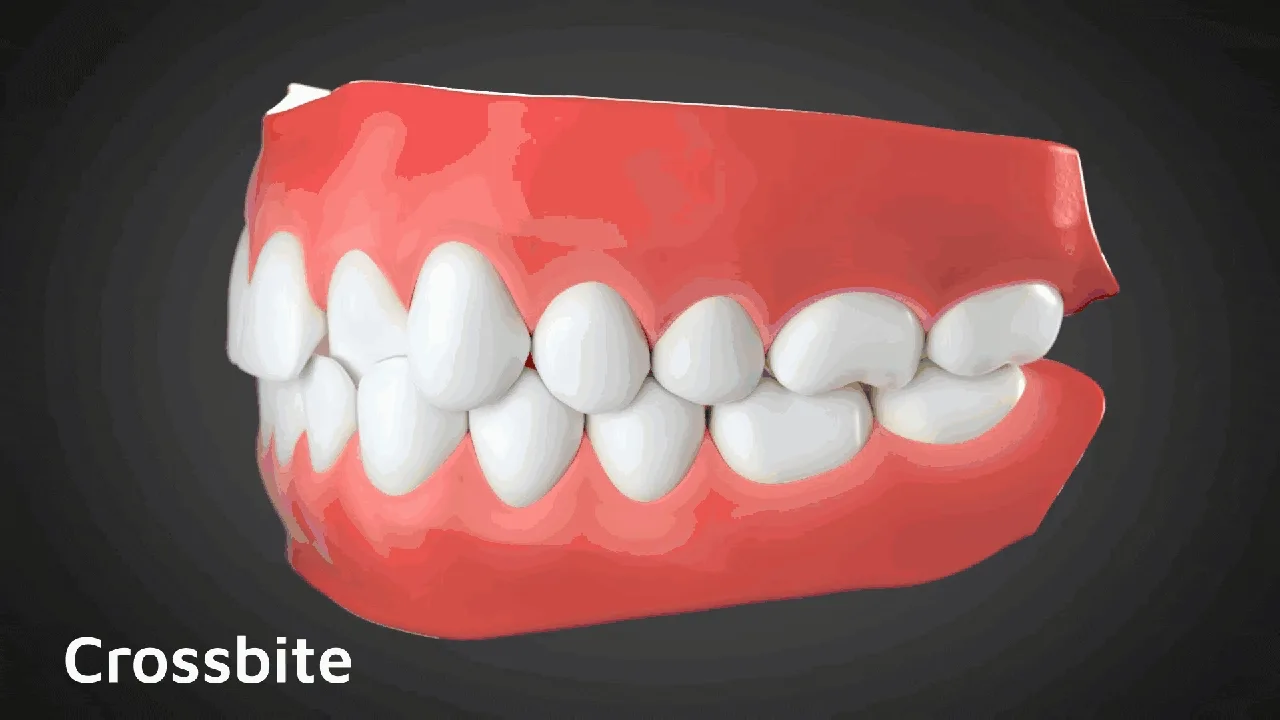 ฟันสบไขว้