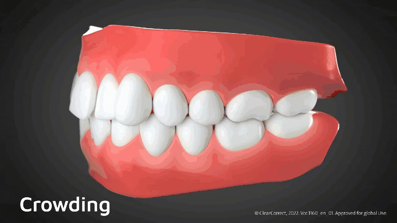 ฟันซ้อน