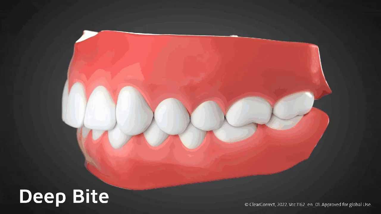 ฟันสบลึก