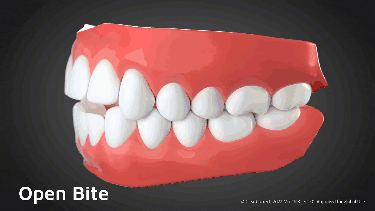 ฟันสบเปิด