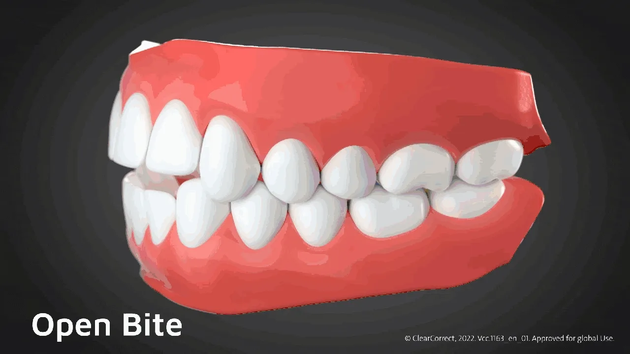 ฟันสบเปิด