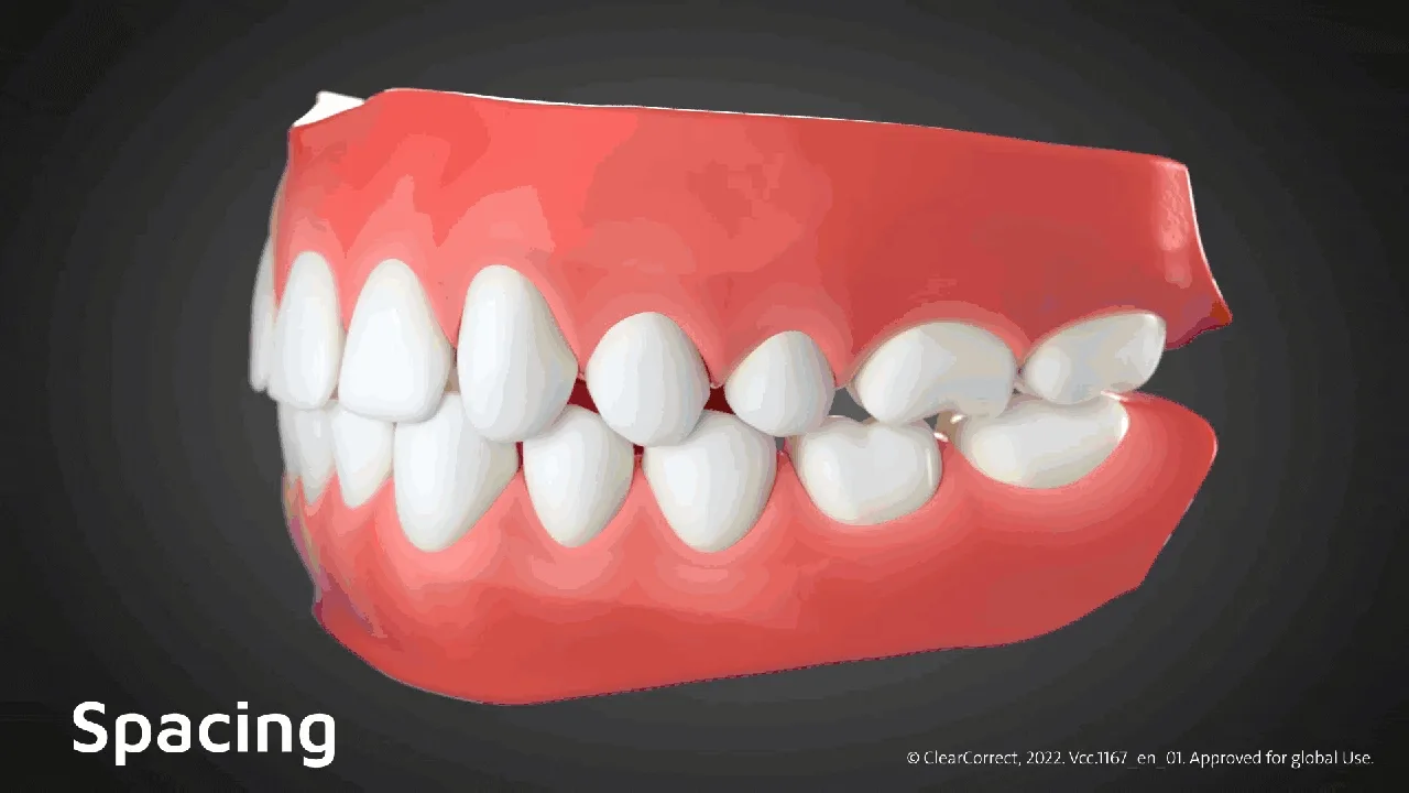 ฟันห่าง